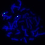 Deletion der SHOX-Region im kurzen Arm eines X Chromosoms